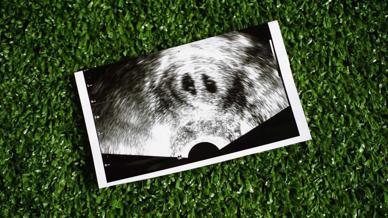 A photo of fetal ultrasound | Source: Shutterstock