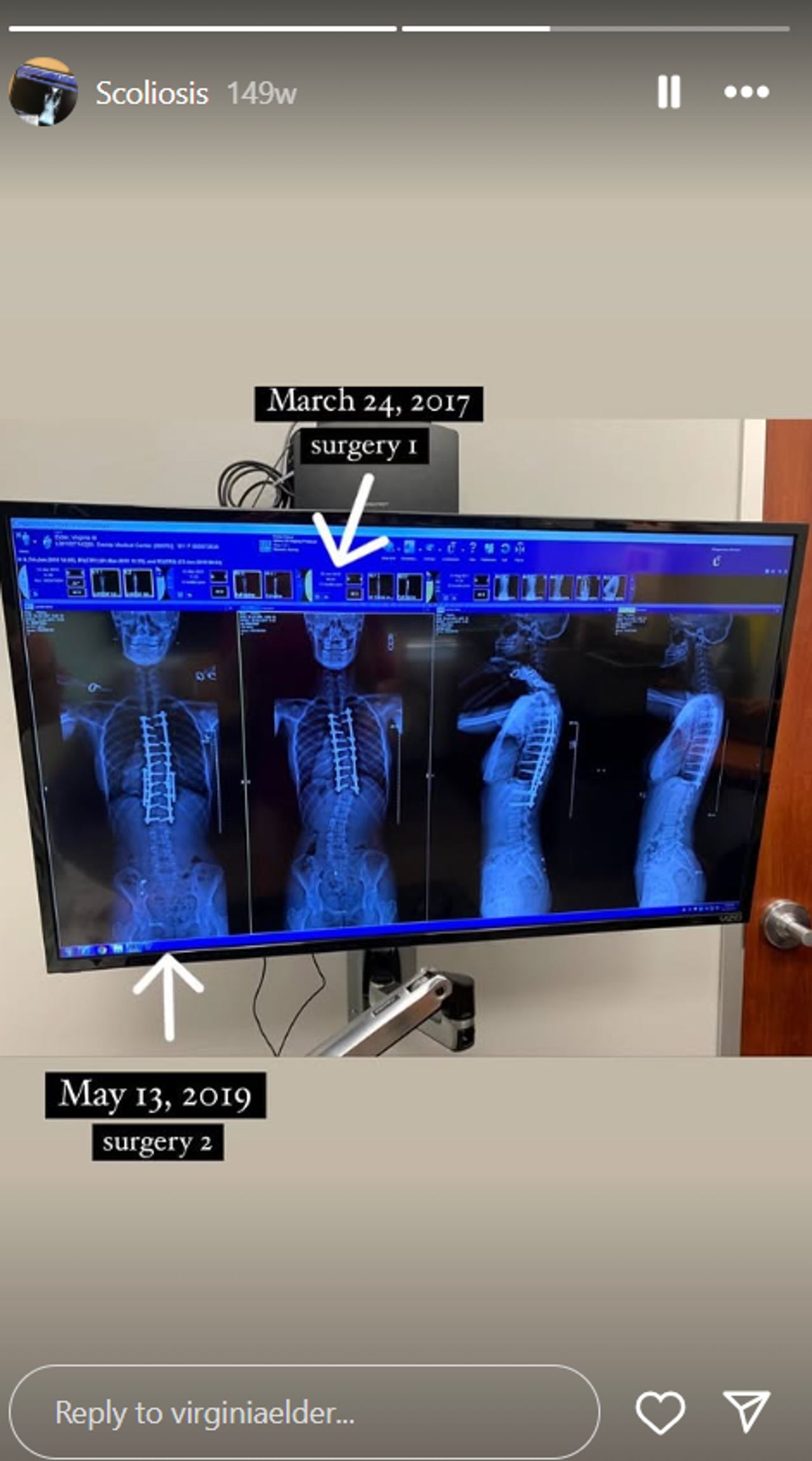 Two major spinal surgeries — in 2017 and 2019 — helped Virginia Elder stabilize her scoliosis with extensive hardware. | Source: Instagram/virginiaelder